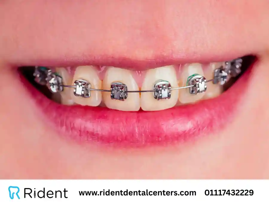 متى تبدأ الأسنان تتحرك بعد التقويم